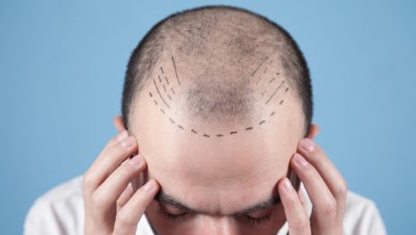 hiv pozitif hastalarda saç ekimi hiv pozitif hastalarda saç ekimi