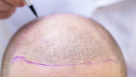 saç neden dökülür saç neden dökülür