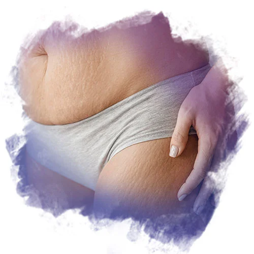 glutathione for lipedema What is Lipedema? What are the Symptoms of Lipedema?