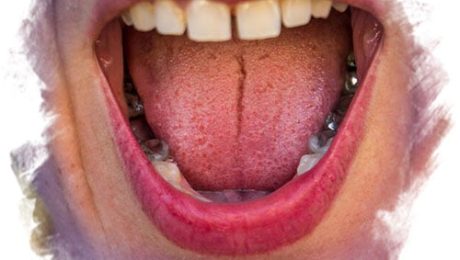 ağız ve dil yüzeyinde pamukçuk