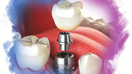 All-On-Four-ve-All-On-Six-Nedir-Nasıl-Uygulanır All On Four