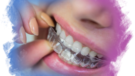Invisalign Tedavisi