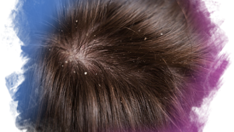 Kepeklenme Kepeklenme ile Saç Dökülmesi