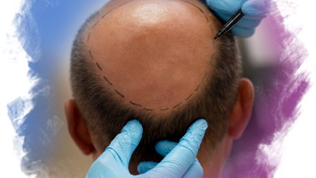 Saç Ekimi Sonrası Kızarıklık Saç Ekimi