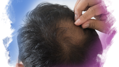 Saç Ekimi Saç Ekimi