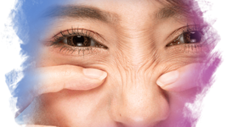 Bunny Lines Bunny lines, burun köprüsünün yanlarında ve üst kısmında mimik sırasında ortaya çıkan ince kırışıklıklardır.