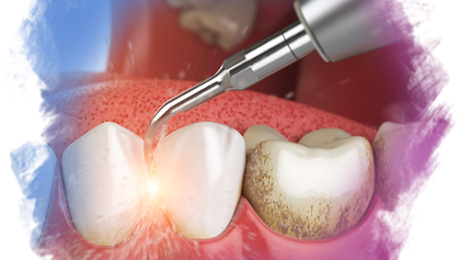 Diş Taşı Temizliği Diş Taşı Temizliği Nedir?