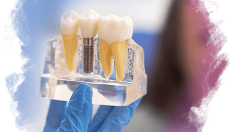 1 Günde İmplant - Aynı Gün İmplant