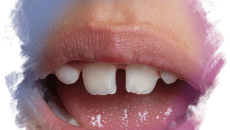 Diş Arası Boşluklar (Diastemalar) Tedavisi