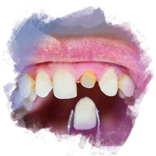 Diş Eti Papil Kaybı Nedir Tedavisi Nasıldır