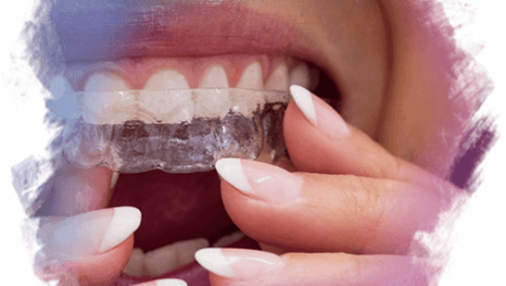 Invisalign – Şeffaf Plak Nedir Nasıl Uygulanır