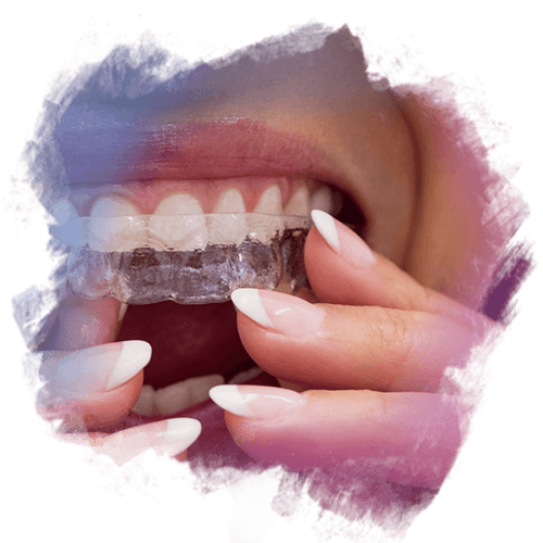 Invisalign – Şeffaf Plak Nedir Nasıl Uygulanır