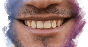 Kemik Rengi Sarı Olan Diş Nasıl Beyazlar