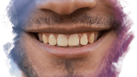 Kemik Rengi Sarı Olan Diş Nasıl Beyazlar