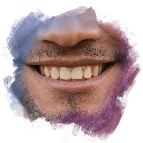 Kemik Rengi Sarı Olan Diş Nasıl Beyazlar