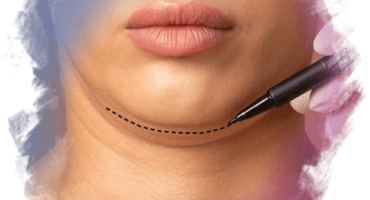 Gıdı Estetiğinde Liposuction mı Boyun Germe mi?