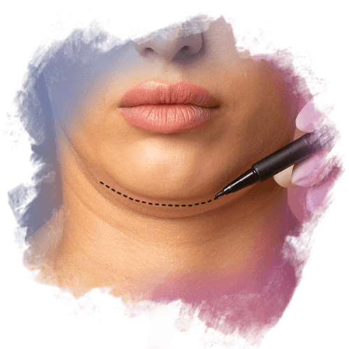 Gıdı Estetiğinde Liposuction mı Boyun Germe mi? Gıdı Estetiğinde Liposuction mı Boyun Germe mi?